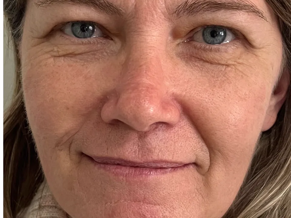 Antes, full face, caso 1