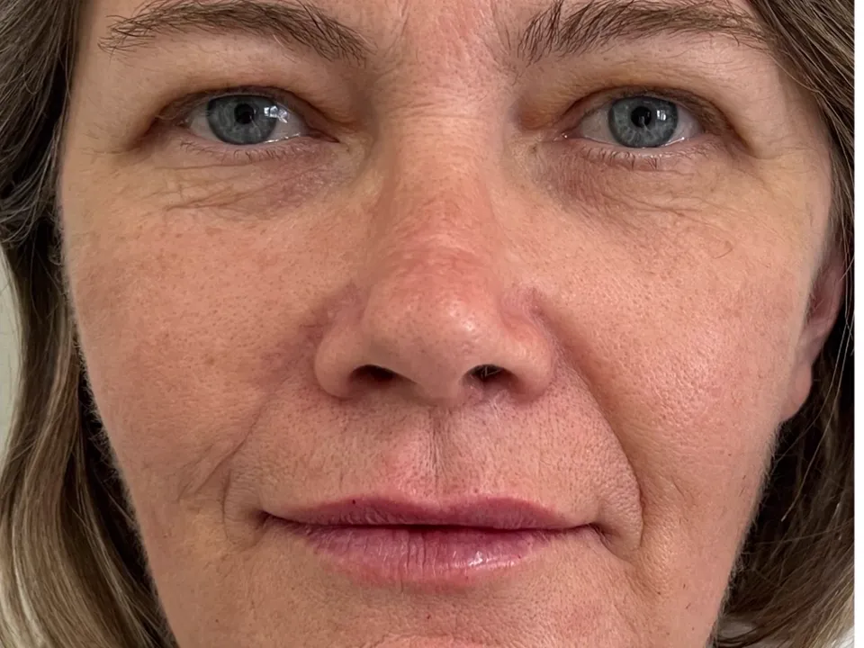 Depois, full face, caso 1