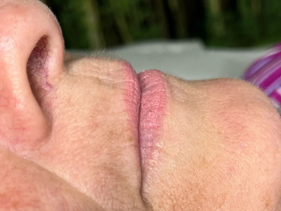 Antes, preenchimento labial, caso 1