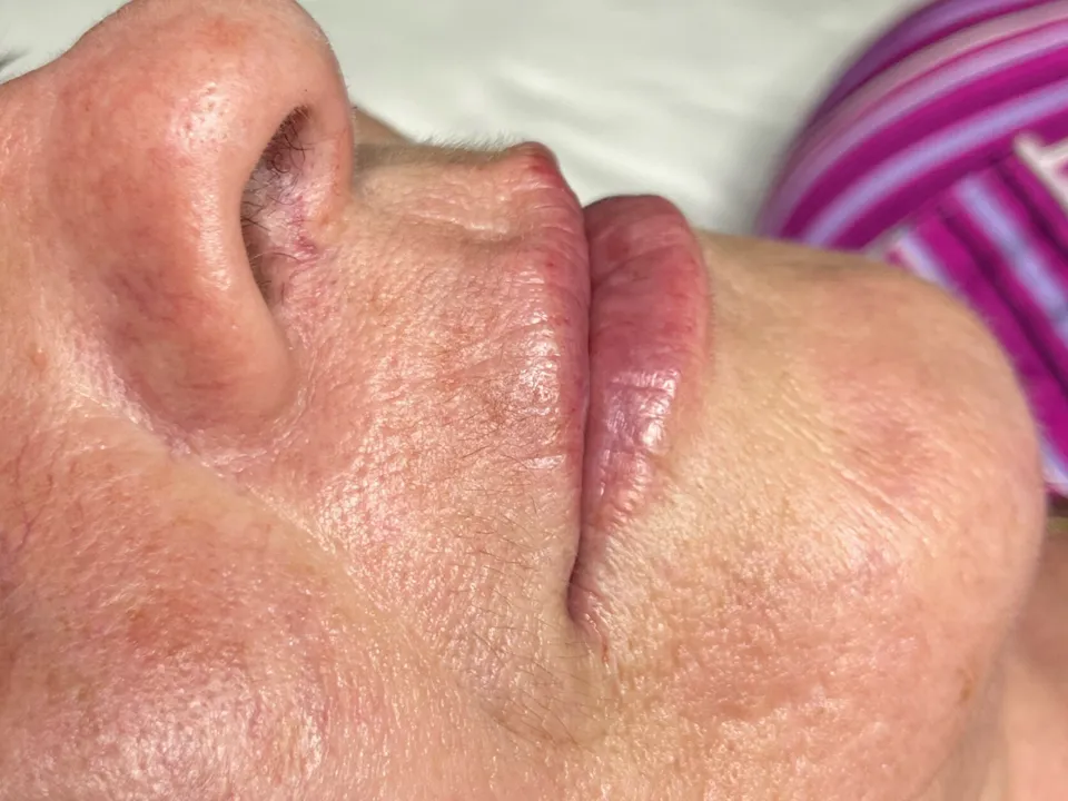 Depois, preenchimento labial, caso 1