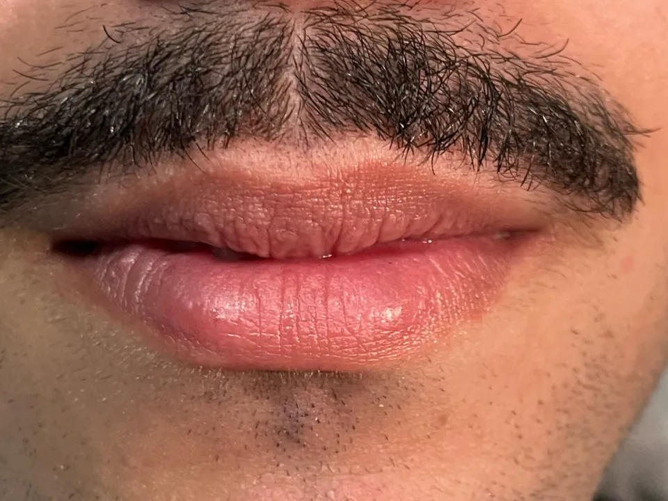 Antes, preenchimento labial, caso 2