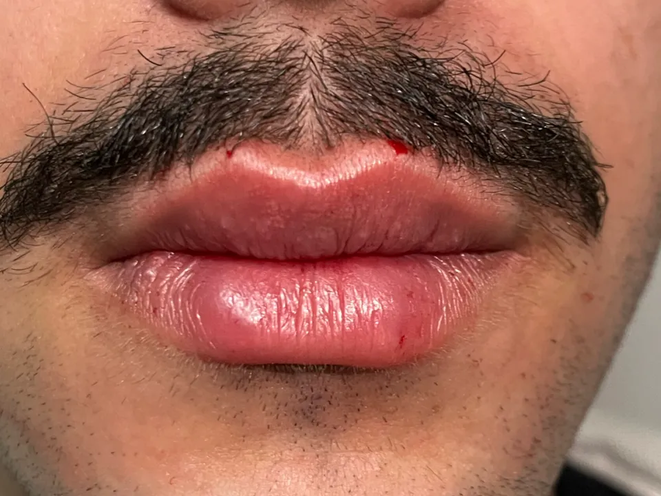 Depois, preenchimento labial, caso 2