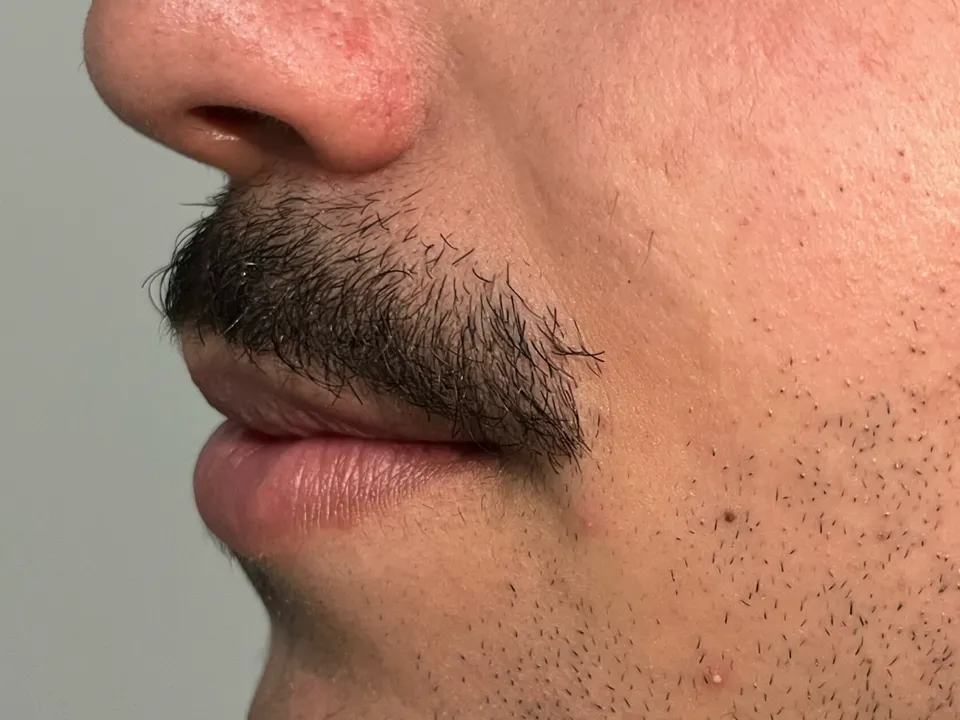 Antes, preenchimento labial, caso 3