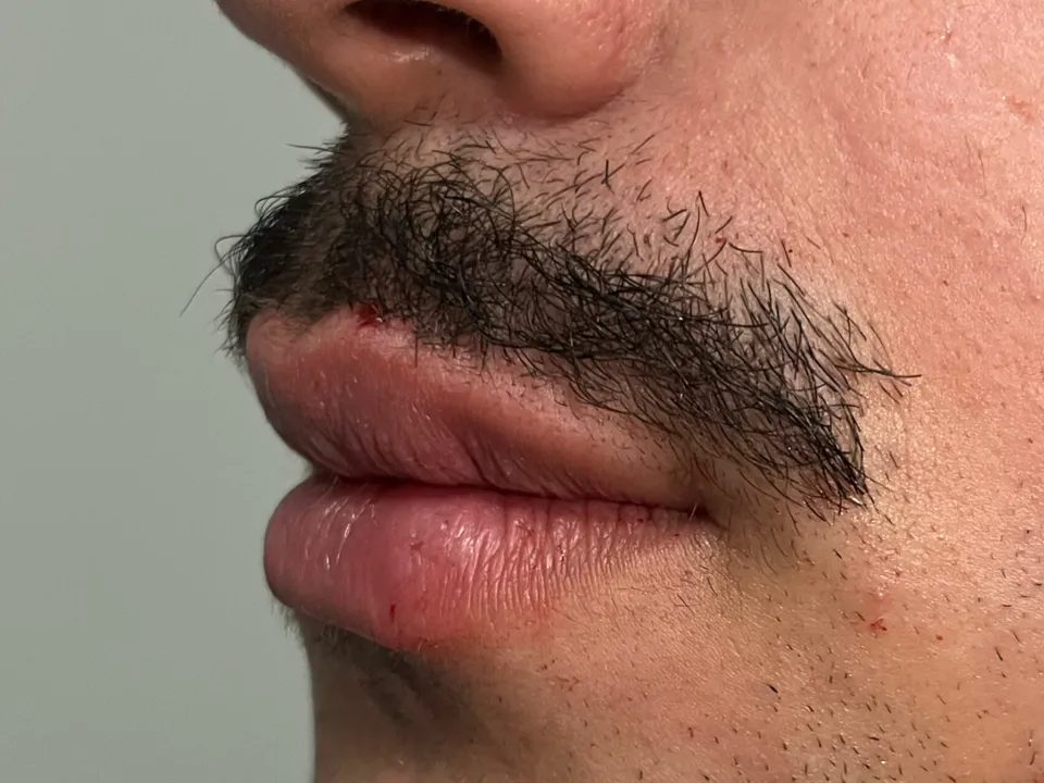 Depois, preenchimento labial, caso 3