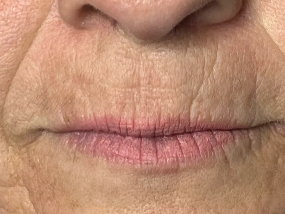 Antes, preenchimento labial, caso 4
