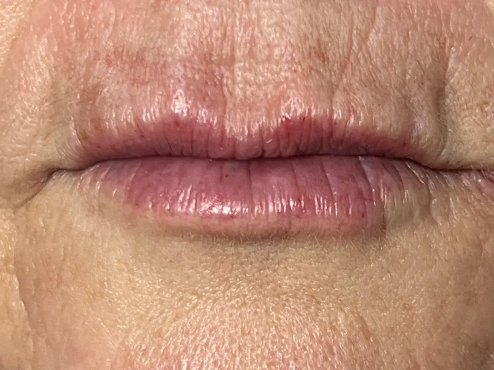 Depois, preenchimento labial, caso 4