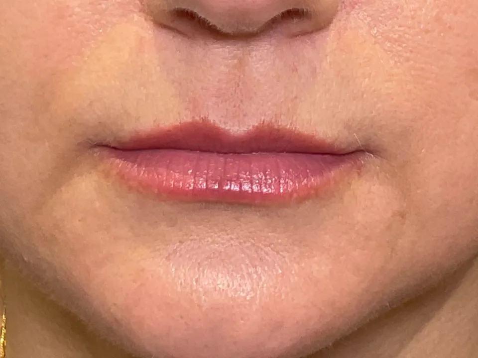 Antes, preenchimento labial, caso 5