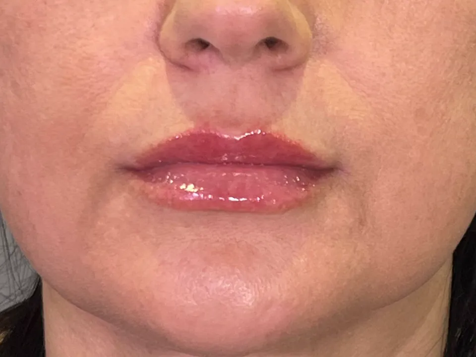 Depois, preenchimento labial, caso 5