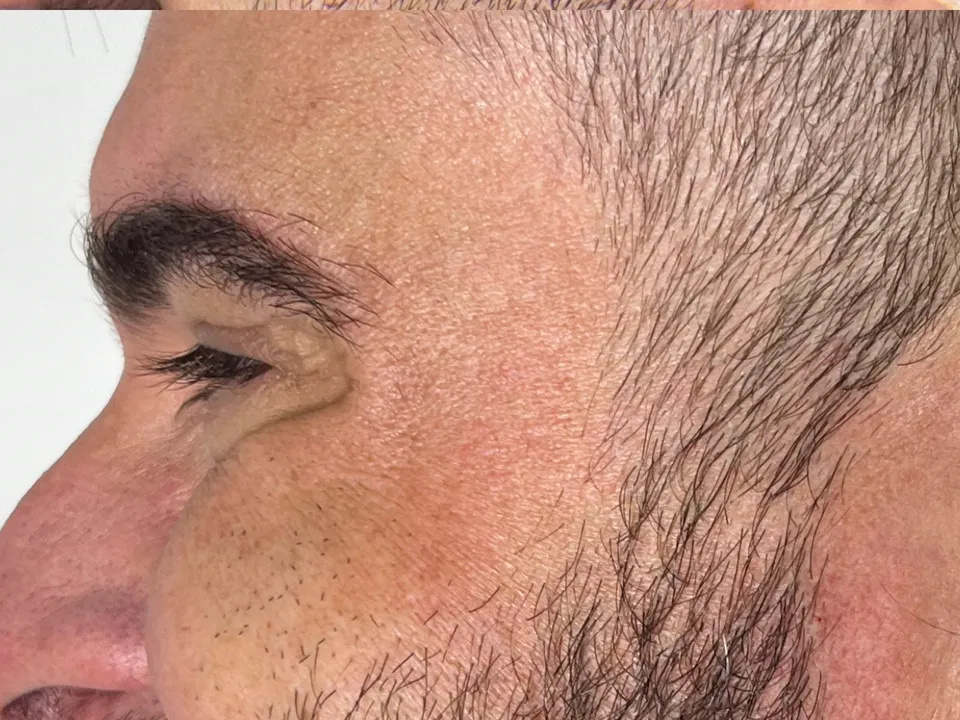 Depois, toxina botulínica, caso 3